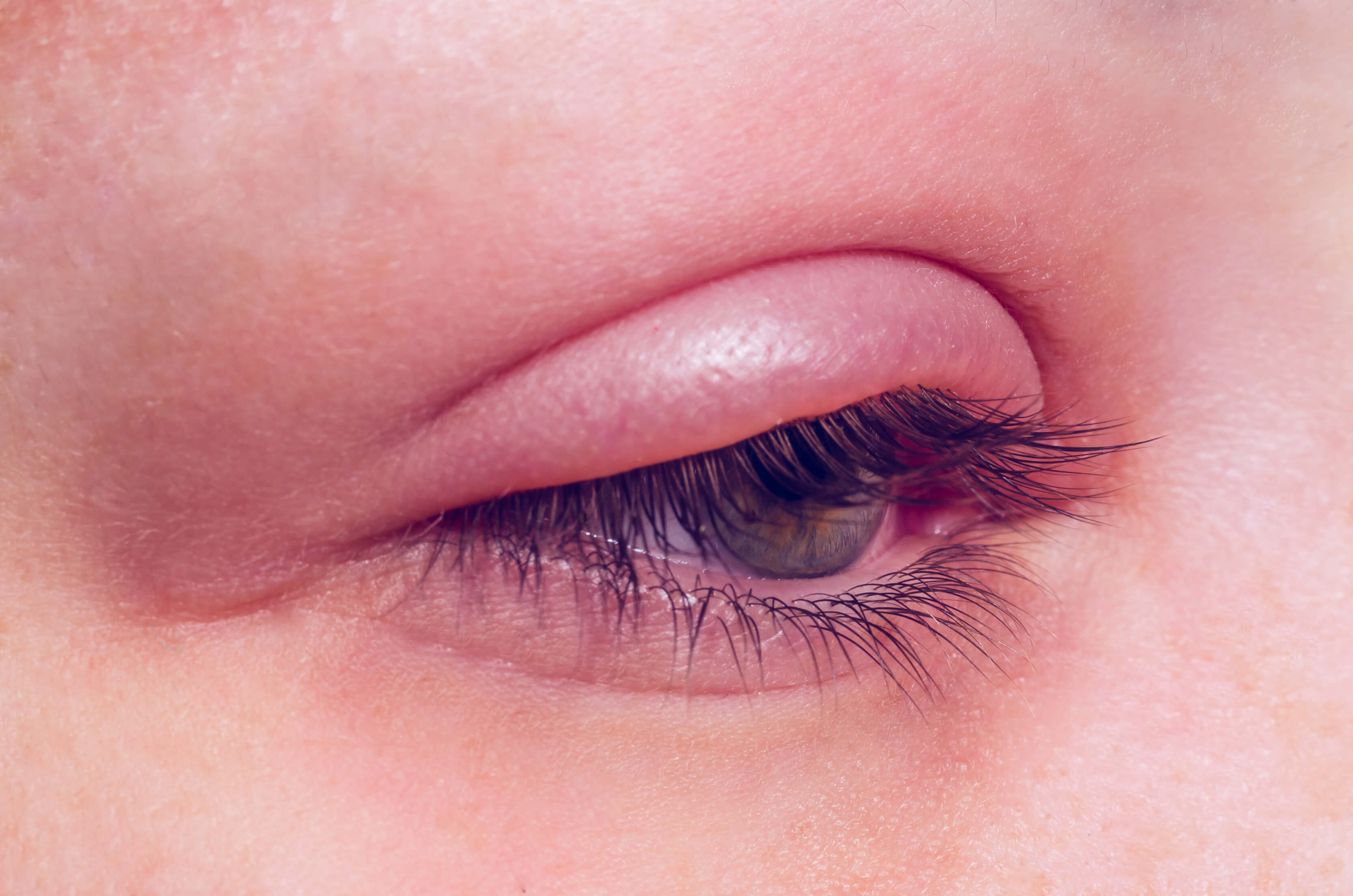 blefaroplastia opeluce fotos