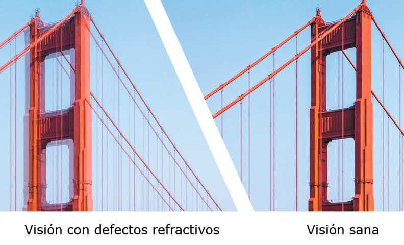 defectos refractivos opeluce 2207